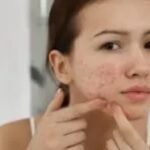 Acne Treatment
