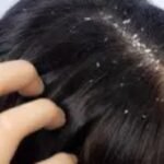 Anti-Dandruff Treatment