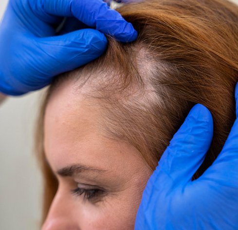 Hairfall-Treatment